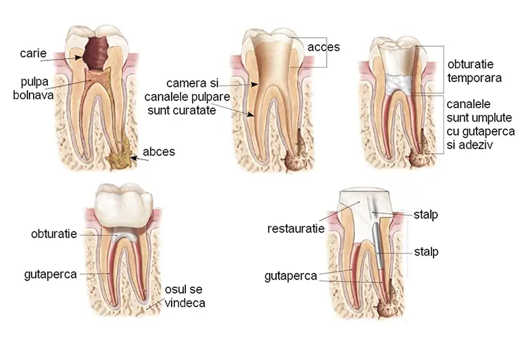 endodonție și tratament de canal în Târgoviște la clinica stomatologică Onodent