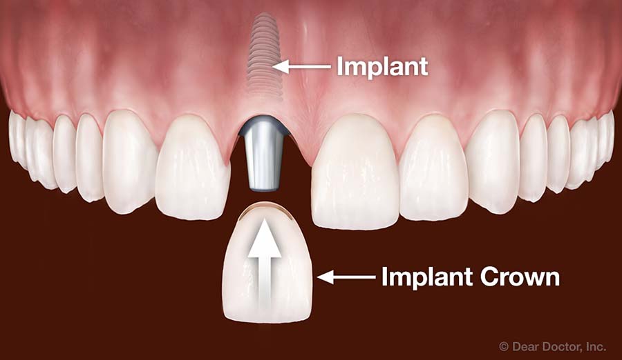 implant dentar pentru un dinte lipsă în Târgoviște la Onodent