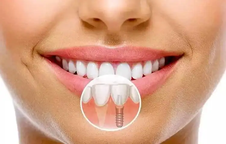 implant dentar în Târgoviște la clinica stomatologică Onodent