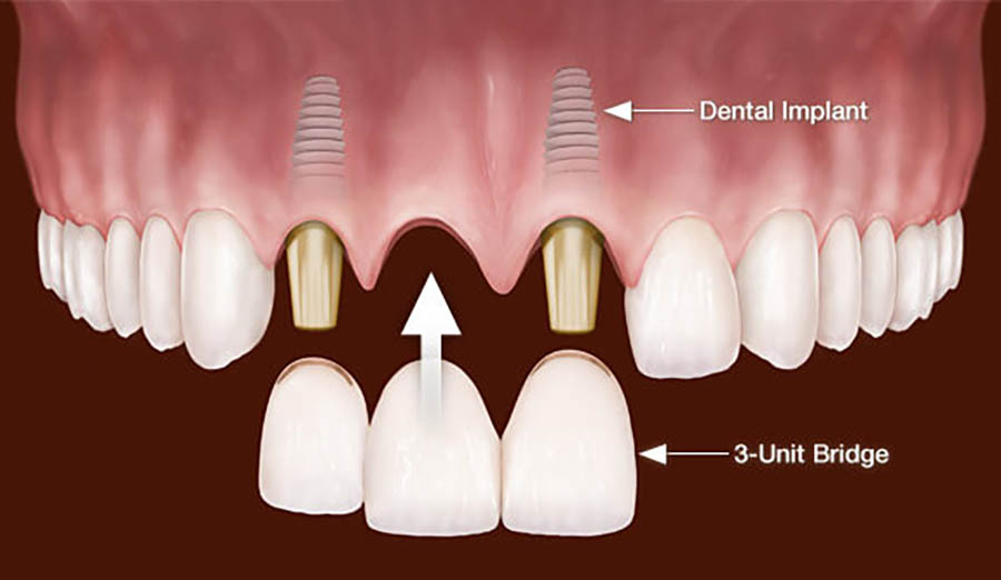 implanturi dentare pentru mai mulți dinți lipsă la Onodent Târgoviște