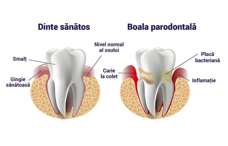 parodontologie în Târgoviște la clinica stomatologică Onodent