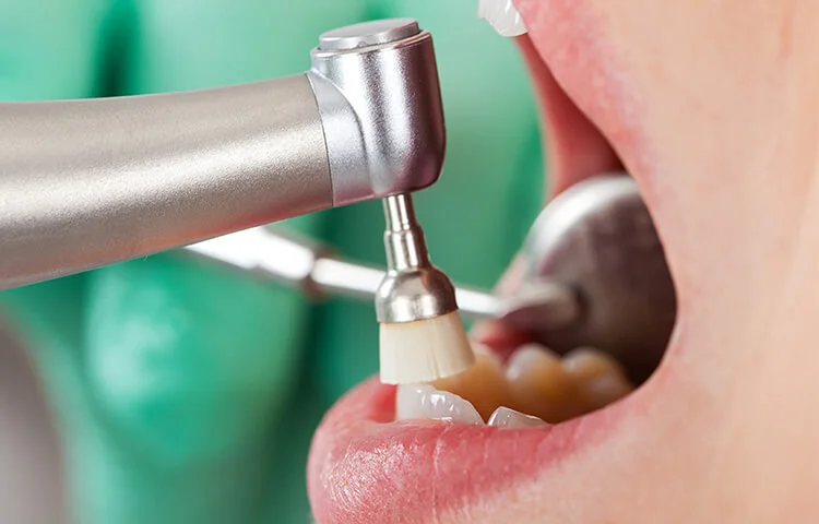 profilaxie dentară și igienizare orală în Târgoviște la clinica Onodent