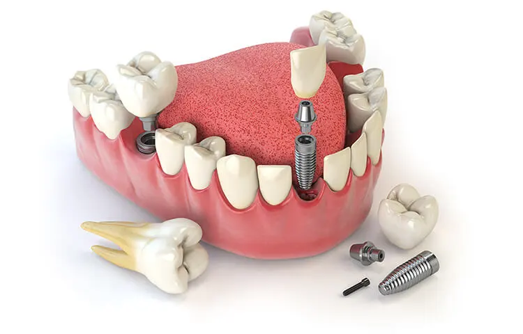protetică dentară în Târgoviște la clinica stomatologică Onodent